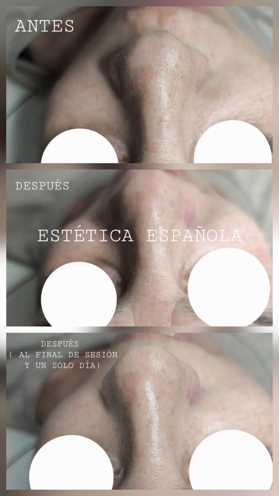 Limpieza Facial — Estética Española